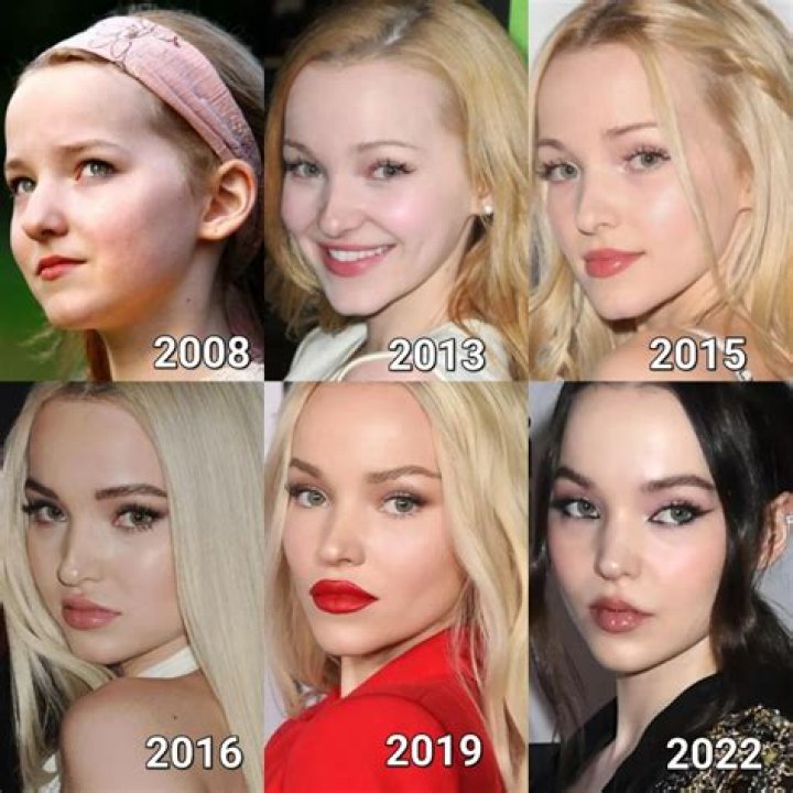 
Has Dove Cameron Done Botox? Fans Suspect Lip Filler And Cheekbone Uplift 