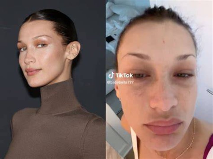
Is Bella Hadid Sick? Battled With Lyme Disease! 