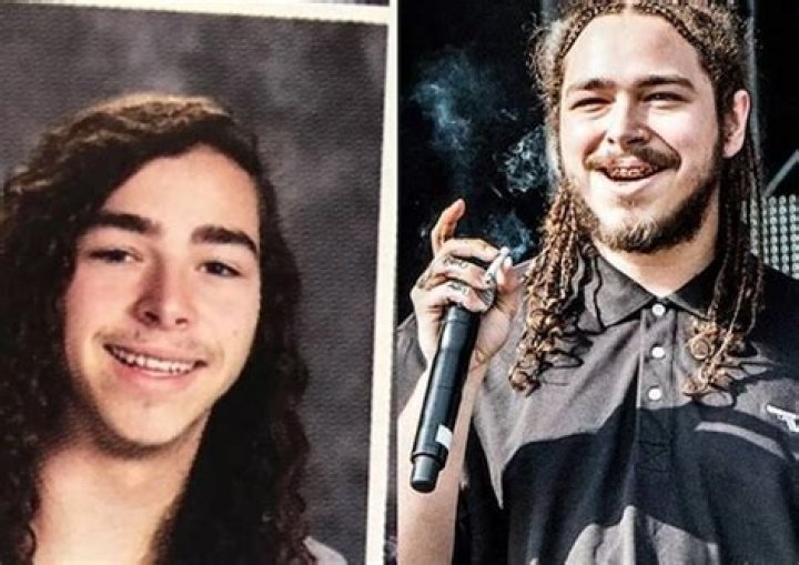 Post Malone Teeth Before And After: What Does He Have On His Teeth?